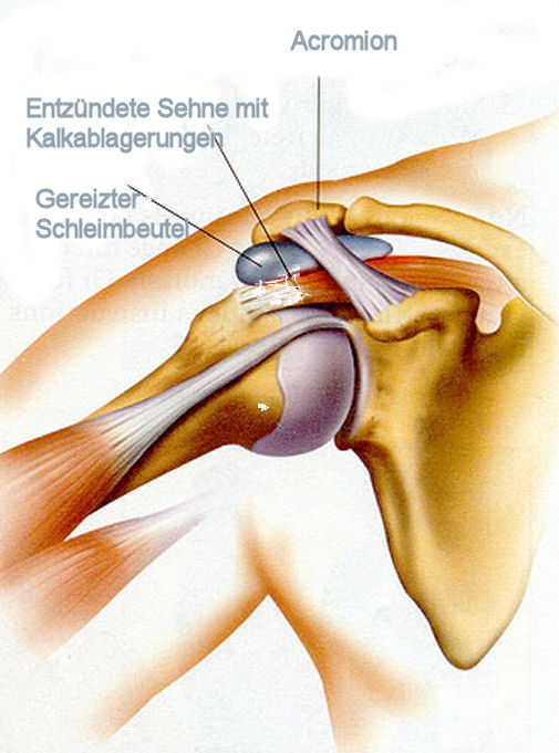 Schemadarstellung einer Tendinitis calcarea mit Schleimbeutelentzündung